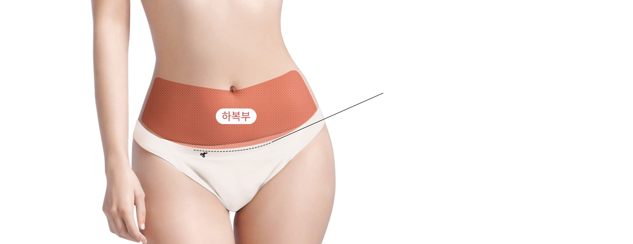 하복부성형